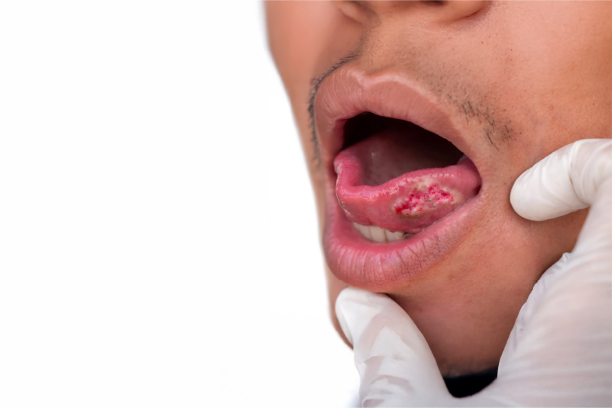 Facial swelling caused by advanced oral cancer