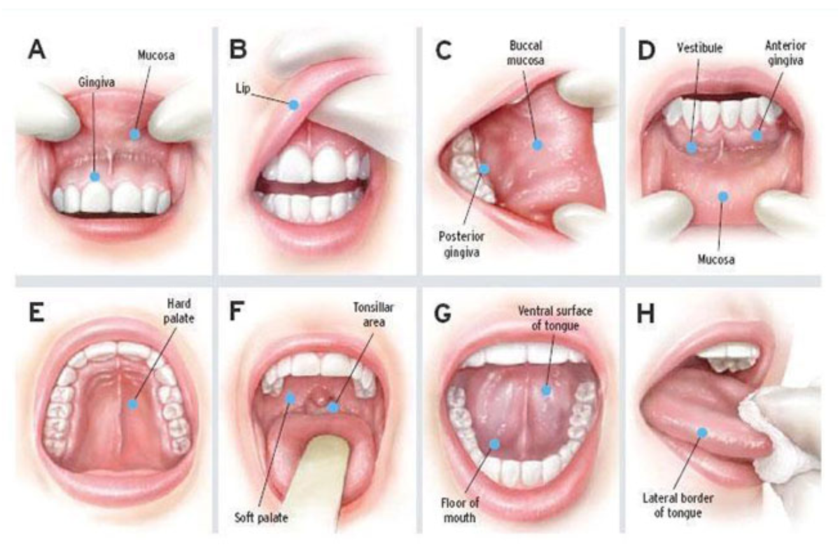 Routine dental screening for early oral cancer detection