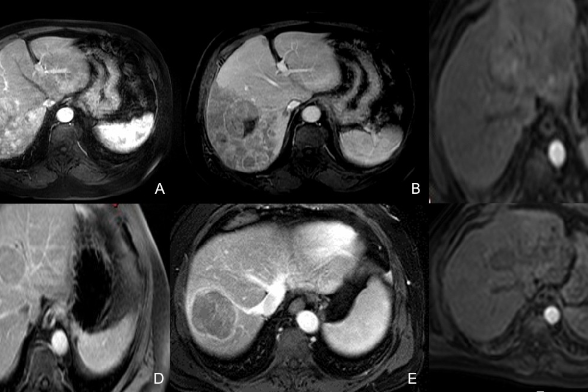 Barcelona Clinic Liver Cancer staging system overview