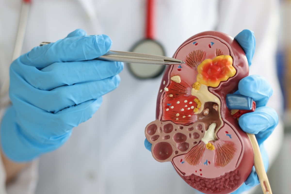 Expert kidney cancer specialist consultation in Chennai