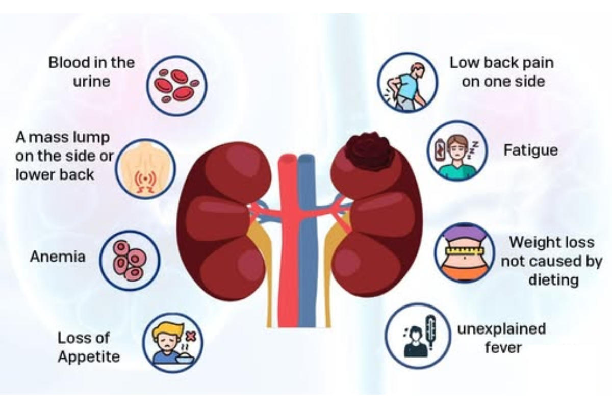 Common warning signs and symptoms of kidney cancer