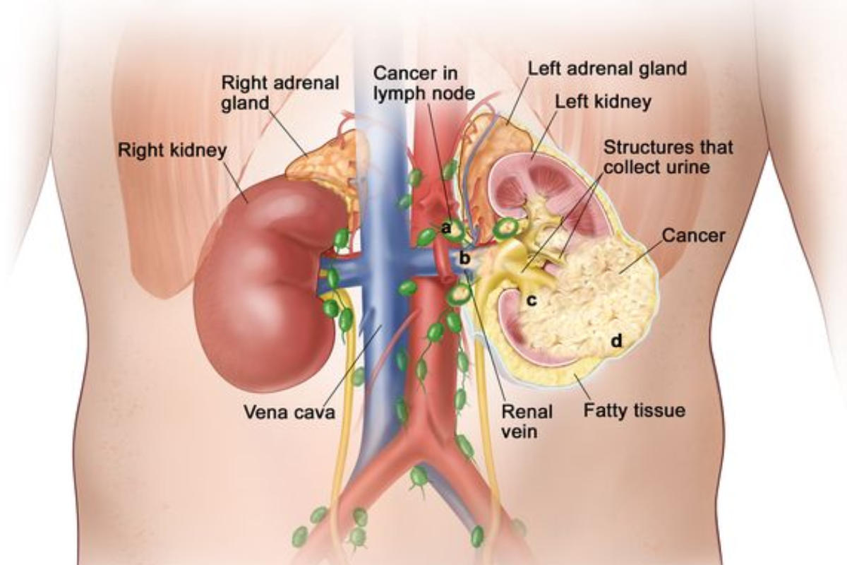 Kidney anatomy showing renal cancer development