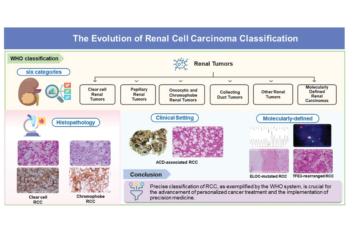 Kidney cancer subtype classification and diagnosis process