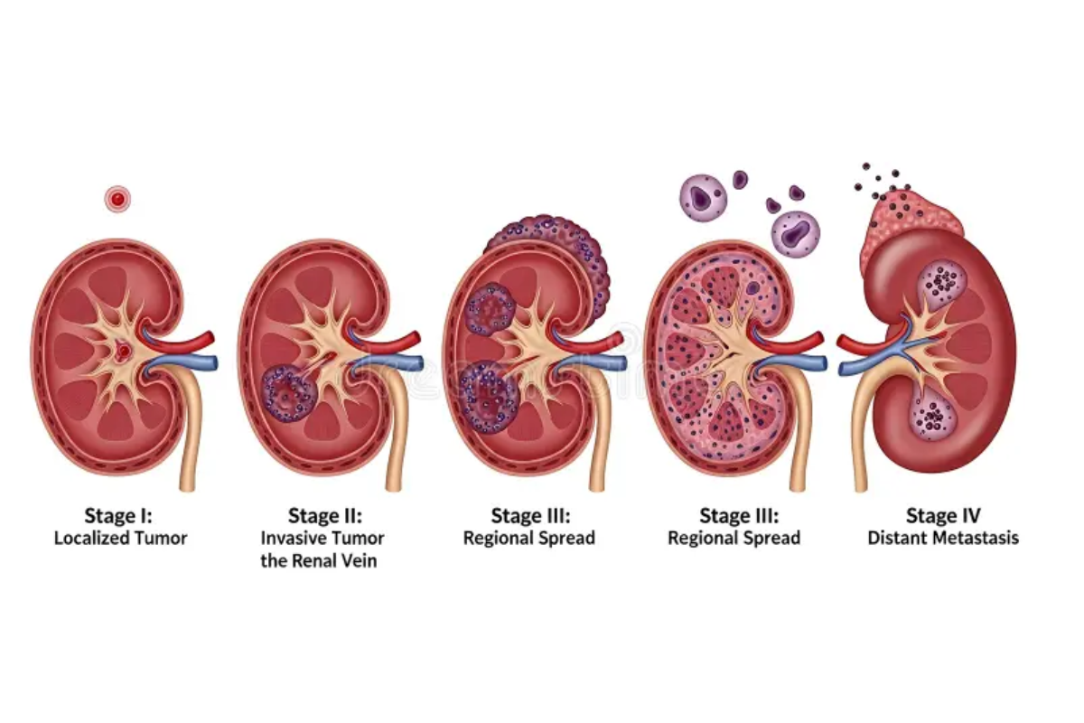 Visual representation of kidney cancer staging