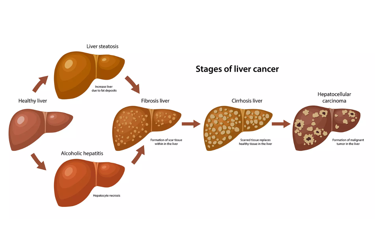 Liver cancer stages from early to advanced disease