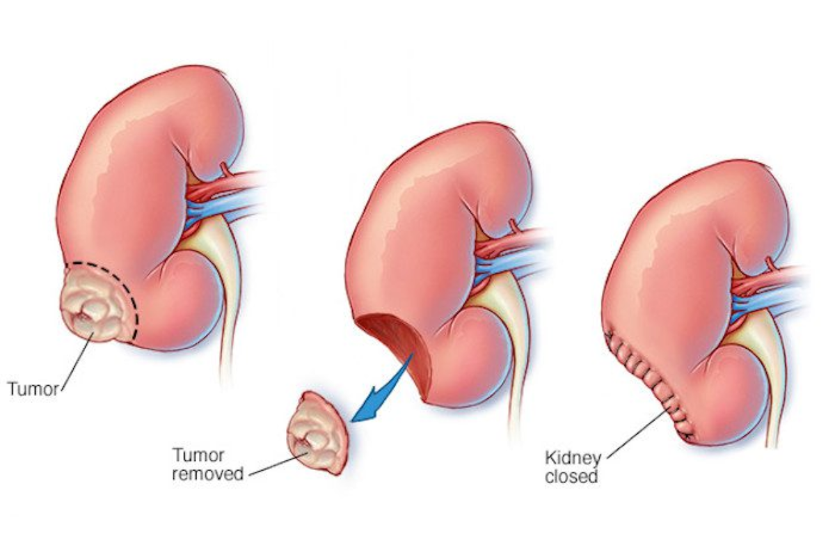 Medical oncology treatment planning for kidney cancer patients