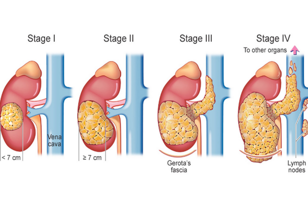 Different types of renal cell carcinoma affecting the kidney